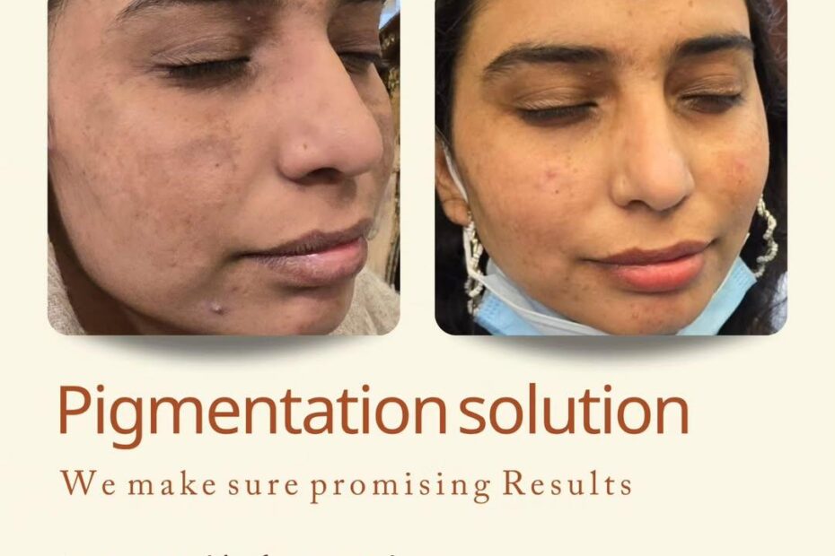 Pigmentation Solutions in Islamabad