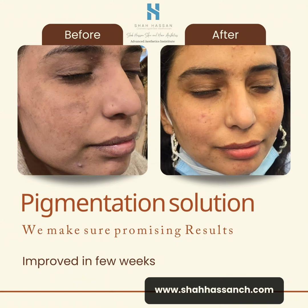 Pigmentation Solutions in Islamabad