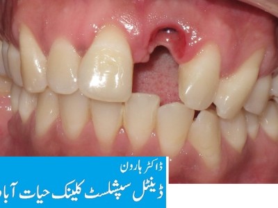 best dental clinic in Peshawar Pakistan, Dr Haroon Dental specialist clinic Hayatabad Peshawar Pakistan, Best Dentist in Peshawar Pakistan, Best Dental Doctor in Peshawar Pakistan, Implant dentist in hayatabad,  Implant dentist Peshawar Pakistan, Dentist