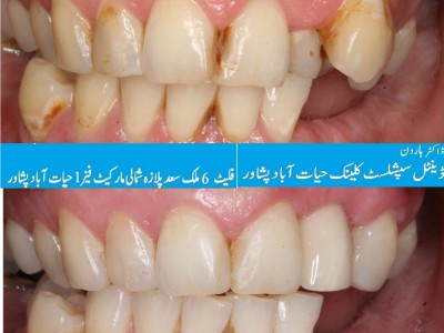 hayatabad best dental clinic in Peshawar, Dr Haroon Dental specialist clinic Hayatabad Peshawar, Best Dentist in Peshawar, Best Dental Doctor in Peshawar, Implant dentist in hayatabad,  Implant dentist Peshawar, Dentist Near me Peshawar, for rct, filling,