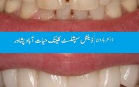 Dental clinic in Peshawar, Dentist in Peshawar, Implant Dentist in Hayatabad Peshawar Pakistan.